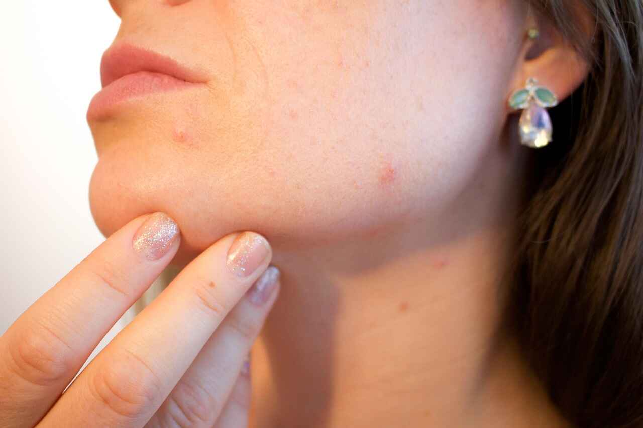 Natural Remedies for hormonal acne